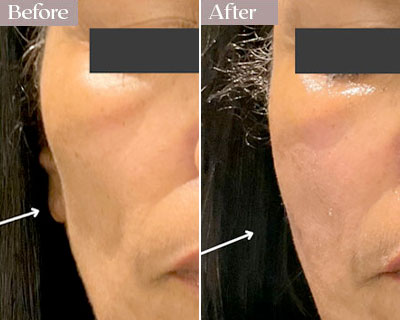 cheek fillers before after nyc